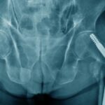 RTG biodra z widoczną operacyjną stabilizacją złamania szyjki kości udowej