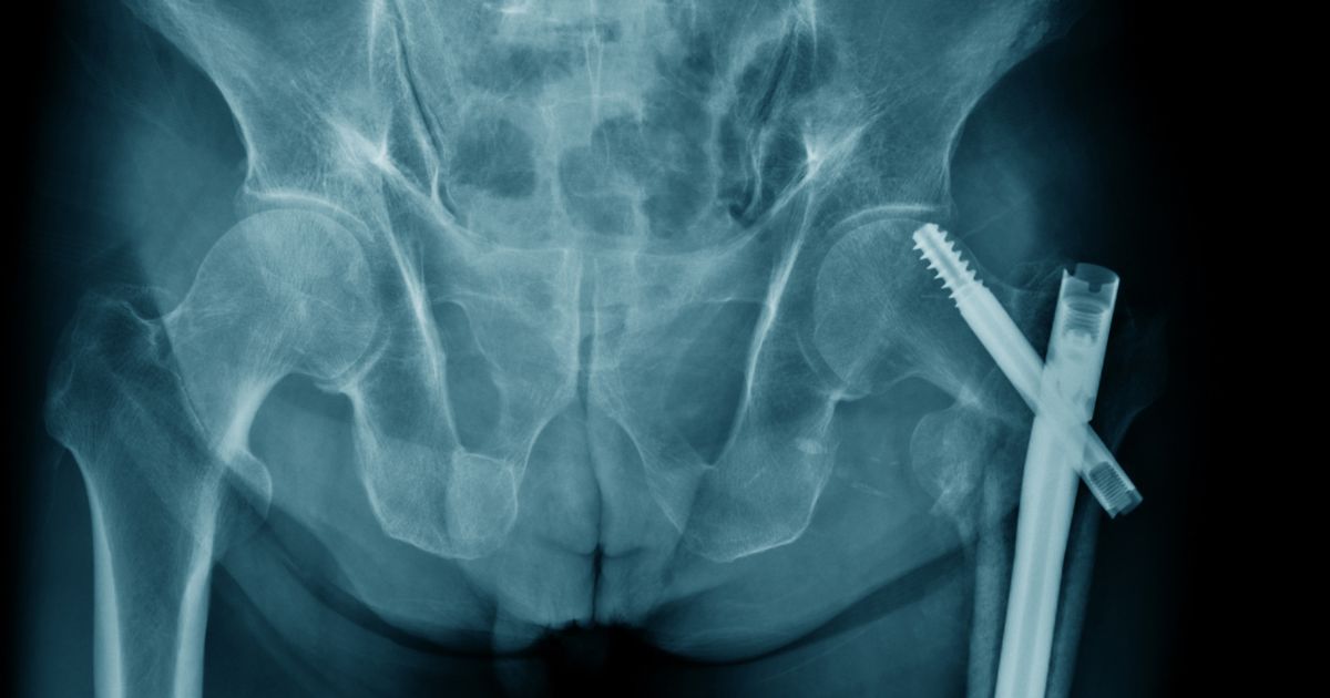 RTG biodra z widoczną operacyjną stabilizacją złamania szyjki kości udowej