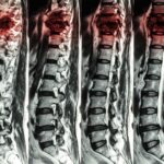 Obrazowanie kręgosłupa lędźwiowego – zmiany zwyrodnieniowe widoczne w rezonansie magnetycznym