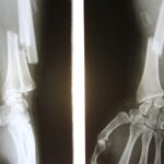 RTG ręki z widocznym złamaniem kości przedramienia – przykład powikłania osteoporozy.