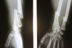 RTG ręki z widocznym złamaniem kości przedramienia – przykład powikłania osteoporozy.