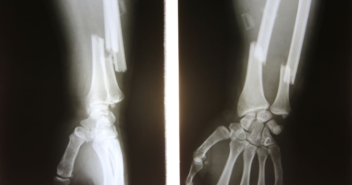 RTG ręki z widocznym złamaniem kości przedramienia – przykład powikłania osteoporozy.