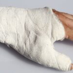 Złamana ręka w gipsie – typowe powikłanie osteoporozy po upadku.