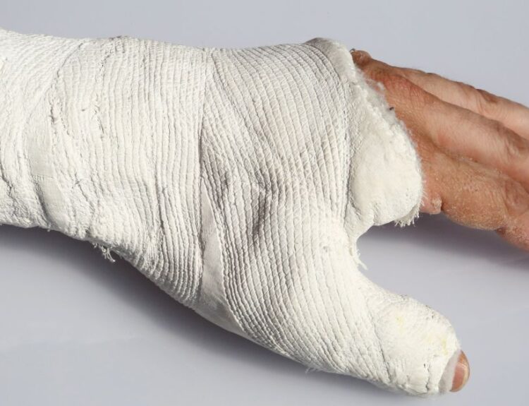 Złamana ręka w gipsie – typowe powikłanie osteoporozy po upadku.