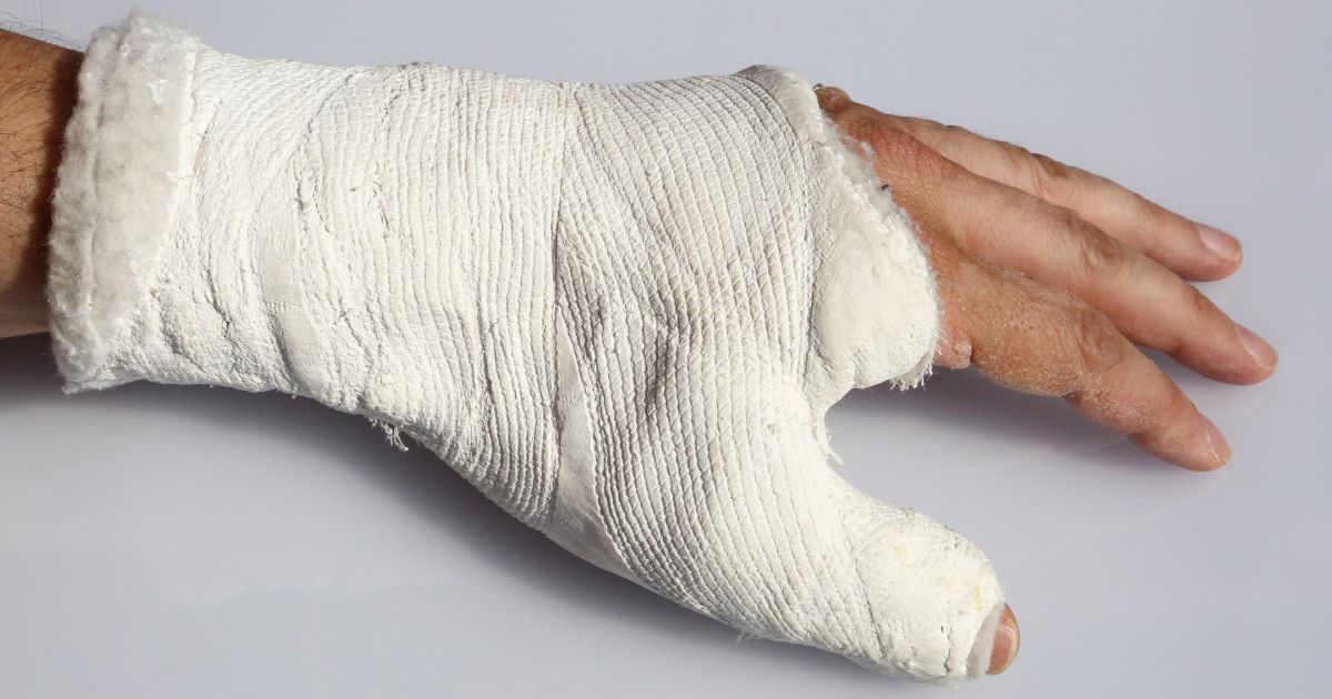 Złamana ręka w gipsie – typowe powikłanie osteoporozy po upadku.